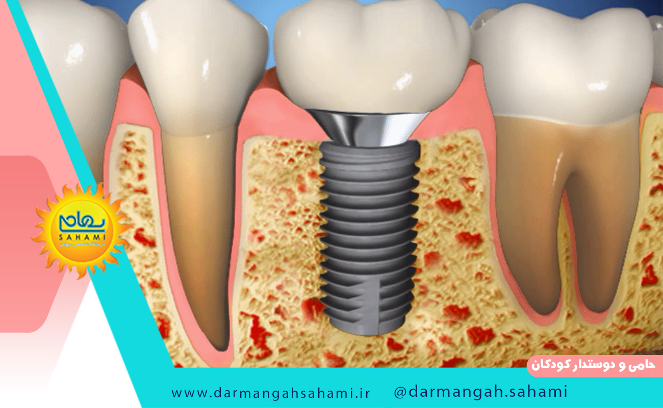 ایمپلنت دندان چقدر طول می کشد؟