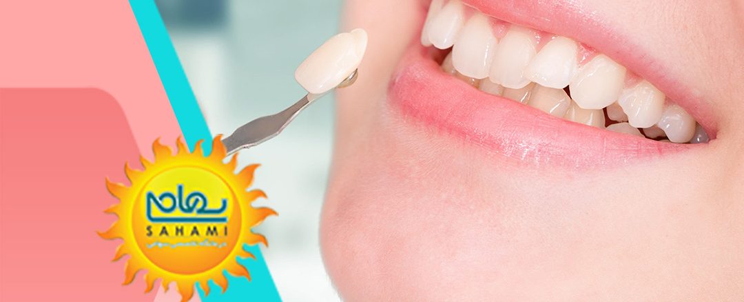 فیسینگ دندان(ونیرکامپوزیت)چیست؟