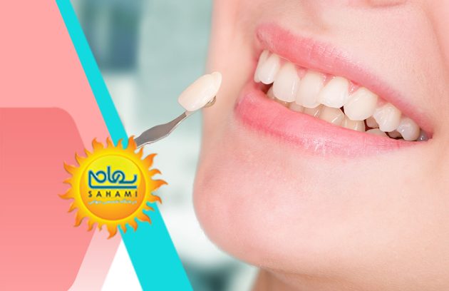 فیسینگ دندان(ونیرکامپوزیت)چیست؟